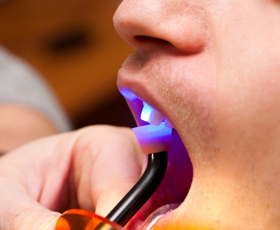 Close up of dental patient getting direct bonding on tooth hardened with ultraviolet light