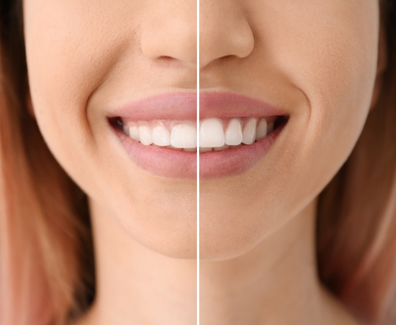 Woman smiling before and after gummy smile correction