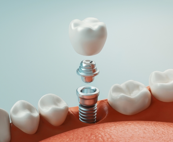 Animated model of dental implant in Danville being placed in the jaw