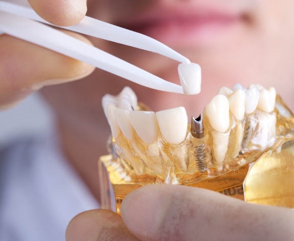 Dental crown being placed on model of dental implant in jaw