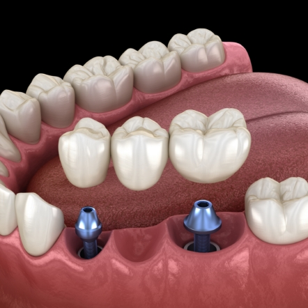 Animated dental bridge being placed over two dental implants