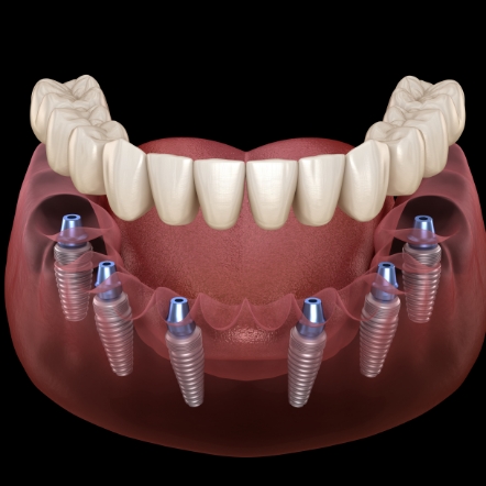 Animated denture being placed over six dental implants