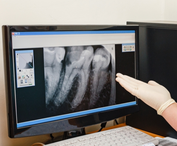 Dentist gesturing to computer screen showing digital x rays of teeth