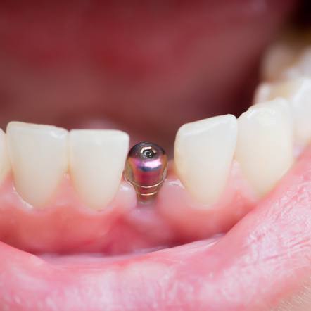 A placed dental implant and its abutment