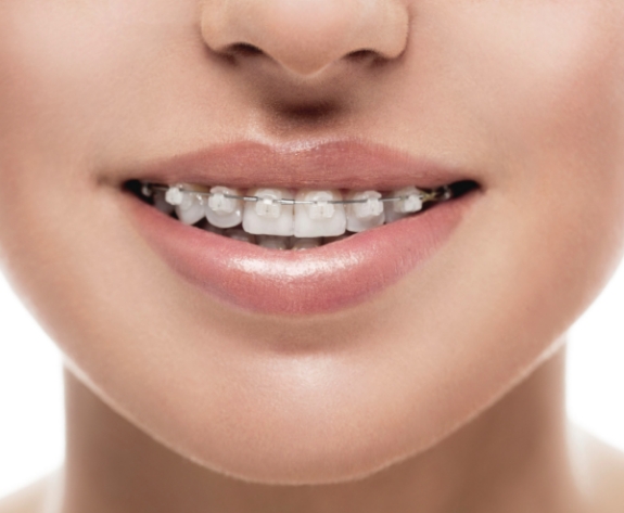 Close up of person smiling with clear ceramic braces