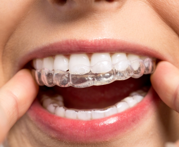 Close up of person placing Invisalign clear aligner in their mouth
