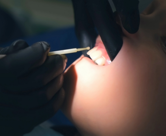 Dentist placing silver diamine fluoride on teeth of child during dental visit
