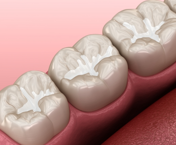 Close up of animated row of teeth with tooth colored fillings