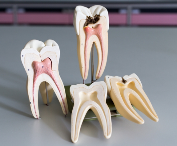 Models of damaged teeth needing pulp therapy