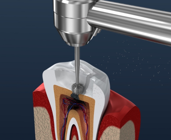 Animated dental tool cleaning inside of tooth during root canal treatment