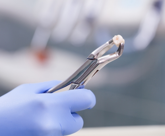 Dental forceps holding a tooth after tooth extraction in Danville