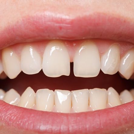 Lady shows crowded teeth