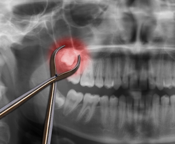 X ray of teeth with impacted wisdom tooth highlighted red
